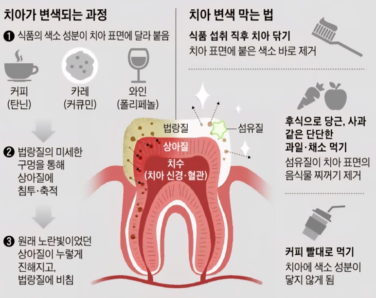 치아미백 시술? 블랑쉬? 어떤 것이 좋을지 고민된다면 관련 이미지 3