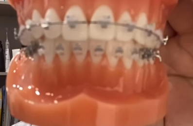 투명교정 vs 메탈교정 비용 비교, 뭐가 더 이득일까? 관련 이미지 5