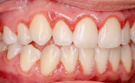 Side Effects of No-Prep Laminates, image 2