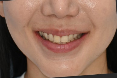 무삭제 라미네이트 비용, 이것만은 꼭 확인했어야 했어요 관련 이미지 15