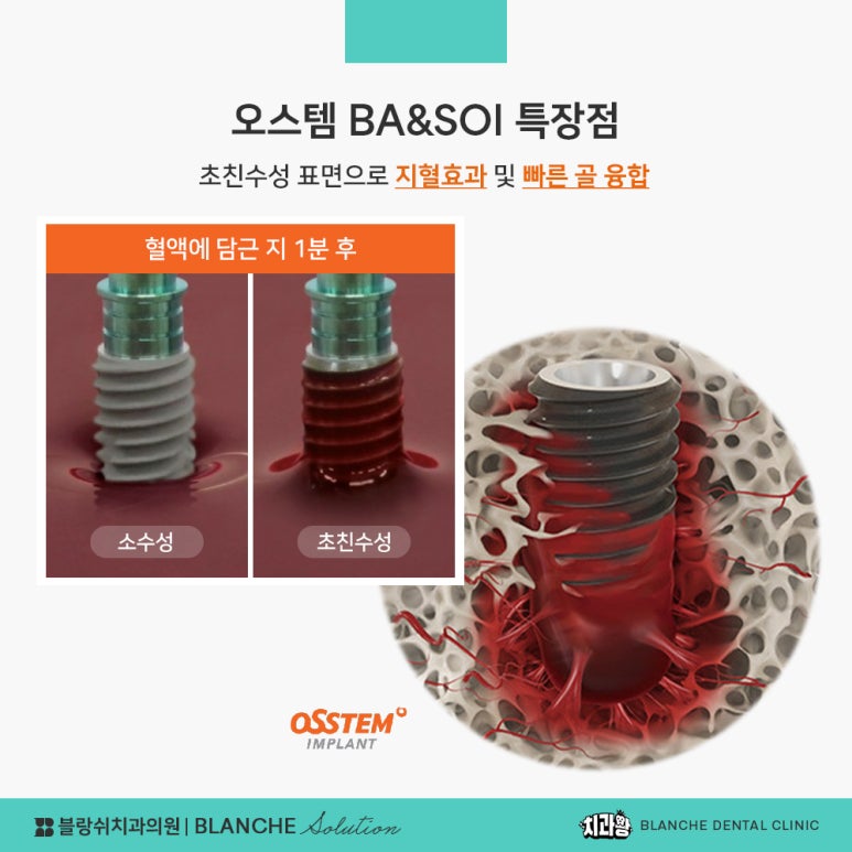 수면임플란트센터, 프리미엄 임플란트 진료는 블랑쉬치과(Blanche Dental Clinic) 관련 이미지 26