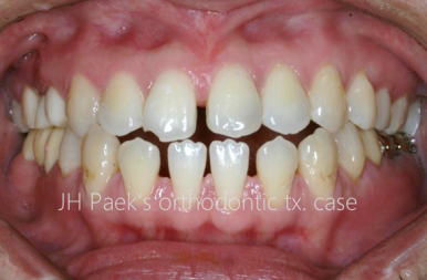반포치과 앞니 부분교정 고려중이라면 필독 관련 이미지 3