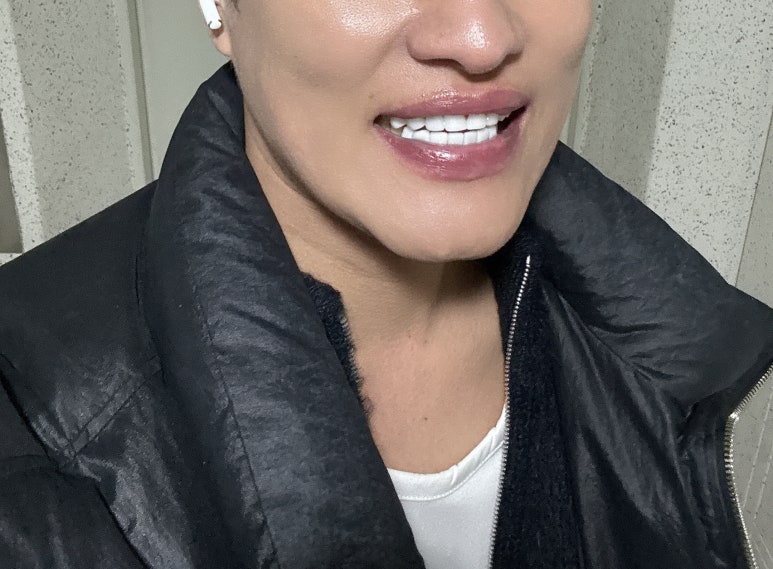 앞니무삭제라미네이트, 정말 잘 알고 계신가요? 관련 이미지 2