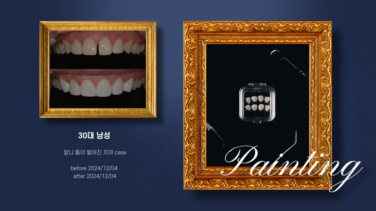 치아 고민별 블랑쉬 적합사례 총정리 관련 이미지 4
