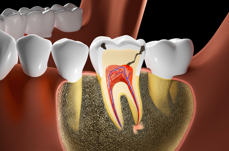 Root Canal Treatment vs. Extraction: When a Dentist Determines That a Natural Tooth Can Be Saved image 4