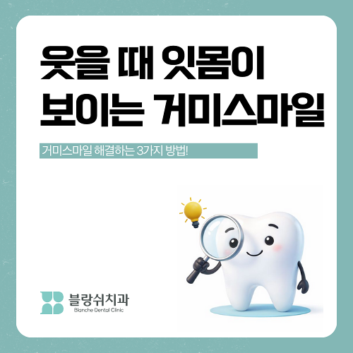 거미스마일 시술 원인 잇몸보임 구강전정술이란 관련 이미지 1