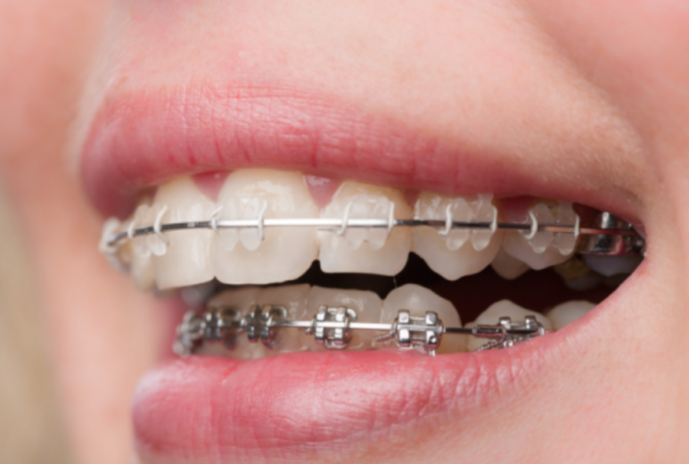 압구정 치아교정 무조건 정답은 아닙니다 관련 이미지 8