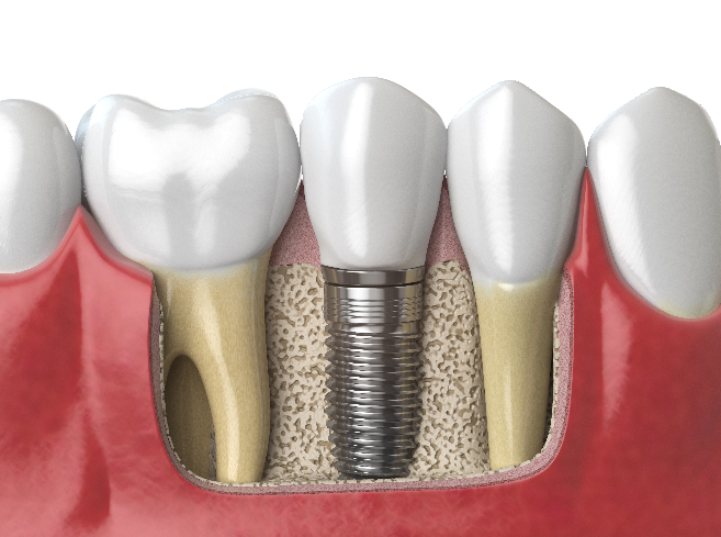When Crown Costs Are Covered by Health Insurance—and When They Aren’t | Differences Between Zirconia and Gold Crowns image 3
