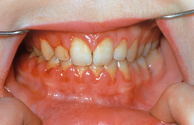 잇몸 부었을 때, 절대로 방치하면 안되는 증상 3가지 관련 이미지 6