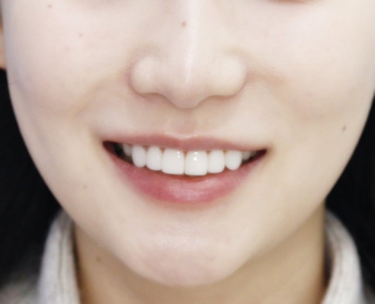 무삭제 라미네이트 후기 시간이 지나면 어떨까요? 관련 이미지 3