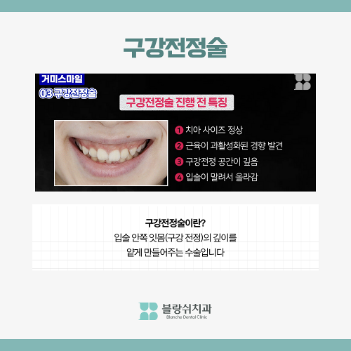 거미스마일 시술 원인 잇몸보임 구강전정술이란 관련 이미지 3