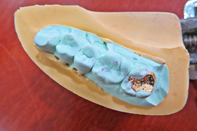 충치치료 비용 건강보험 적용 기준은 관련 이미지 4