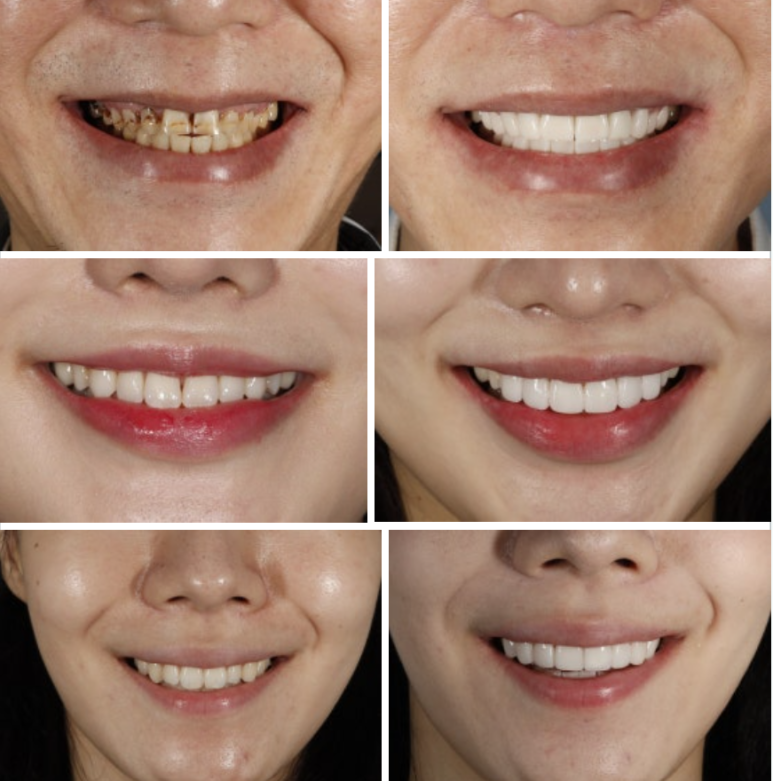 무삭제라미네이트 비용에 관한 숨겨진 진실, 모두 공개합니다. 관련 이미지 7