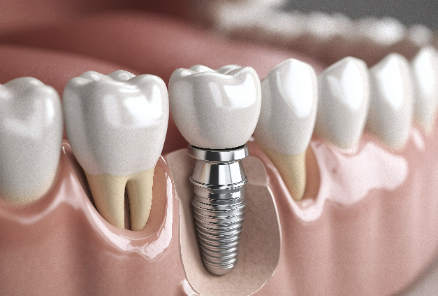 How Much Does a Nonhyeon Dental Implant Cost per Tooth, and Why Does It Differ by Clinic? image 2
