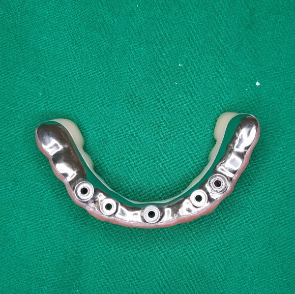 디지털 풀아치 임플란트 비용, 그전에 꼭 따져봐야 할 게 있습니다 관련 이미지 8