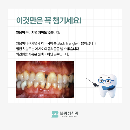 압구정 치과 50대 이후 치아 관리 이것만은 꼭 관련 이미지 4