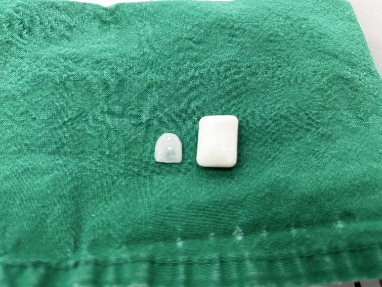 강남라미네이트치과 꼭 알아야 할 기준 2가지 관련 이미지 5