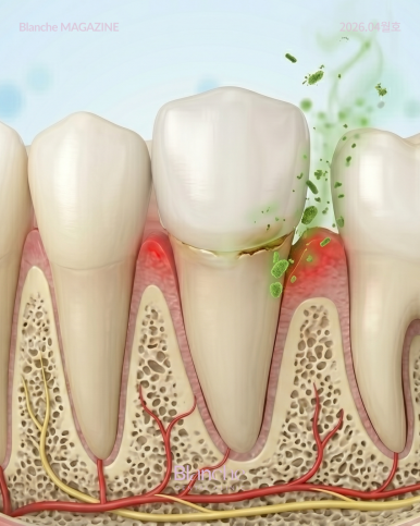 Bad Breath After Laminate Veneers: Is It Normal? Causes and Solutions image 13