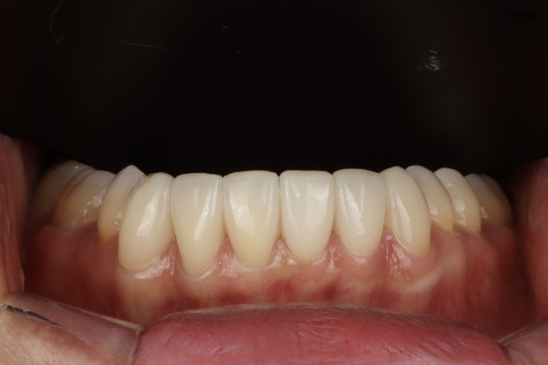 Same-Day Veneers in Korea : Cost, Process & Tips - Blanche Dental Clinic 관련 이미지 6