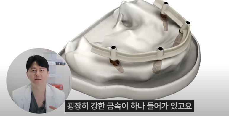 풀아치 임플란트 후기만 믿고 결정하기 전에 꼭 보세요 관련 이미지 7
