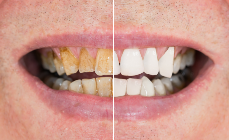 Tooth Sensitivity, Chipping, and Resin Discoloration After an InlayㅣHow to Respond to Symptoms After Cavity Treatment image 5