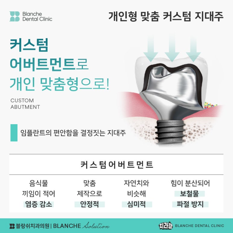 수면임플란트센터, 프리미엄 임플란트 진료는 블랑쉬치과(Blanche Dental Clinic) 관련 이미지 30