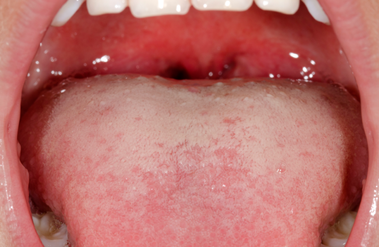 5 Causes of Tongue Coating: Cases That Can’t Be Solved by Brushing Alone image 5