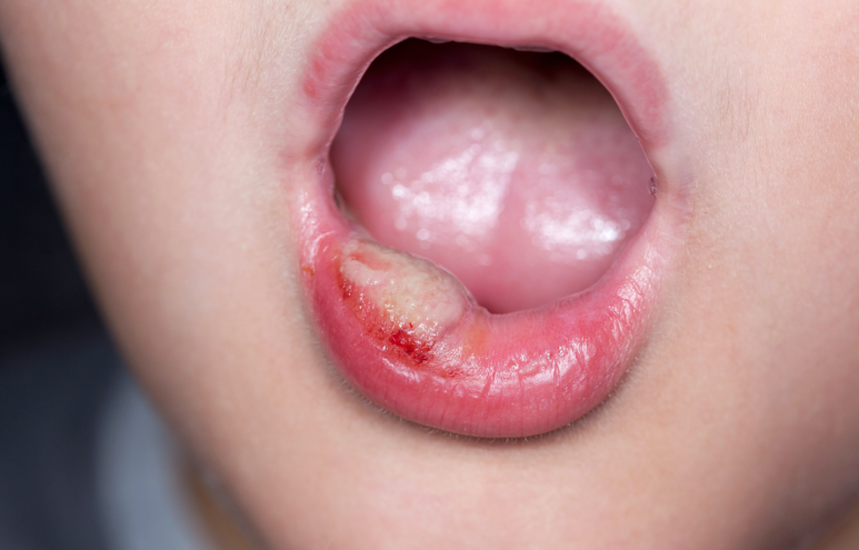 The Real Cause of Canker Sores You May Not Know: A Gangnam Dentist Explains How to Heal Canker Sores Fast image 3