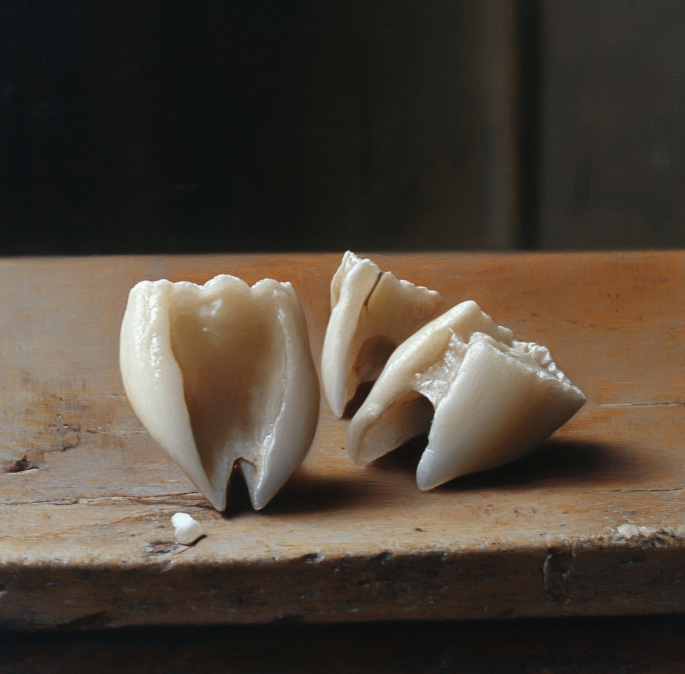 무삭제라미네이트단점? 의사가 말하는 오해와 진실 관련 이미지 5