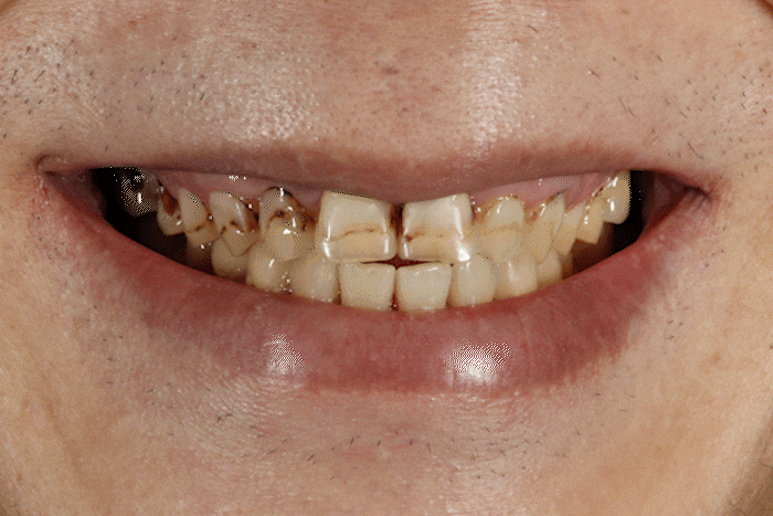 라미네이트 통증 걱정된다면? 가수면으로 편안하게 받으세요 관련 이미지 1