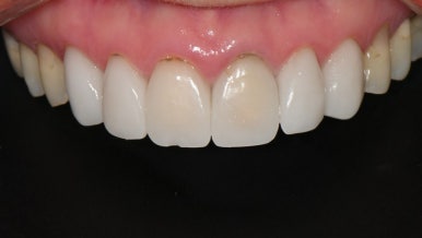 무삭제 라미네이트 가격 비교? 이 글로 정리해드립니다. 관련 이미지 16