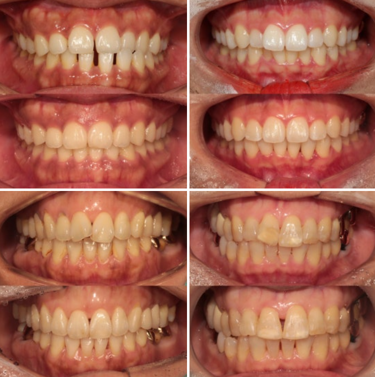 뻐드렁니 교정 2년 고생하고 후회하는 사람 vs 6개월 만에 인생 미소 찾은 사람 관련 이미지 6