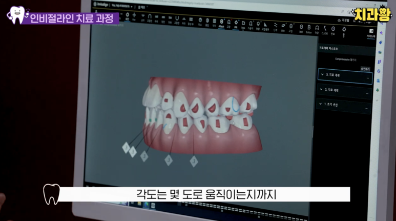 신사동 교정치과 인비절라인 가격 과정 알려드림 관련 이미지 11
