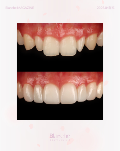 무삭제 라미네이트? 누구나 할 수 없는 진짜 이유 관련 이미지 7