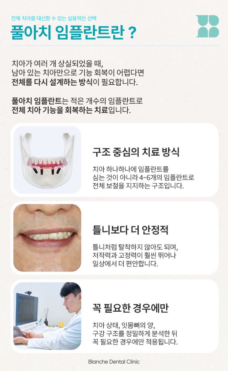 풀아치 임플란트 대상, 치료 시기와 기준을 알려드립니다 관련 이미지 2