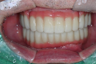 임플란트가 두렵다면 반드시 읽으세요! 관련 이미지 8