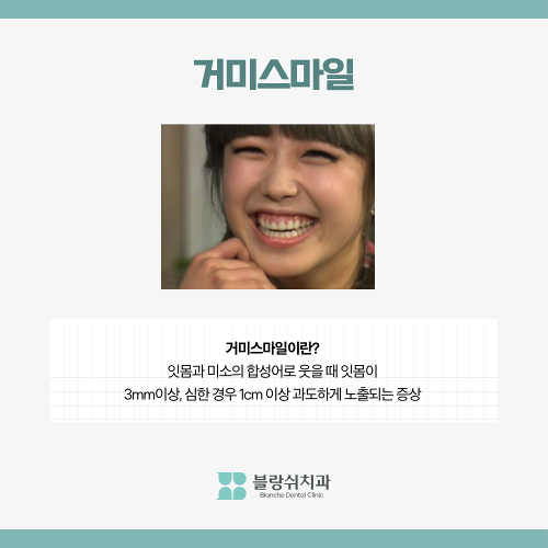 거미스마일 시술 원인 잇몸보임 구강전정술이란 관련 이미지 2
