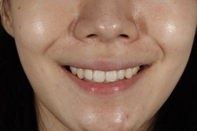 치아미백 라미네이트, 그리고 무삭제 라미네이트의 차이는? 관련 이미지 11