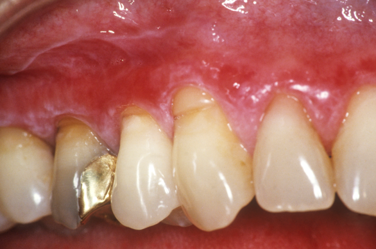 In an Era When Implants Have Become Easier, Why Are Healthy Natural Teeth Being Extracted Too Quickly? image 3