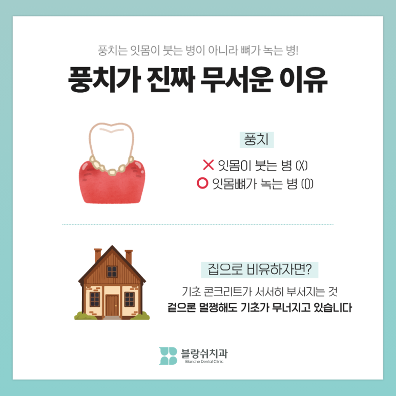 풍치 치료 초기&middot;중기&middot;말기, 단계별 치료비가 10배 차이 나는 이유 관련 이미지 2