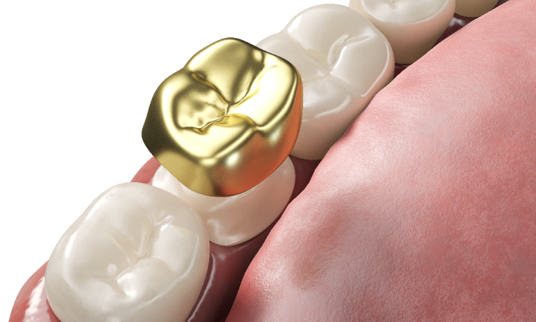 When Crown Costs Are Covered by Health Insurance—and When They Aren’t | Differences Between Zirconia and Gold Crowns image 4