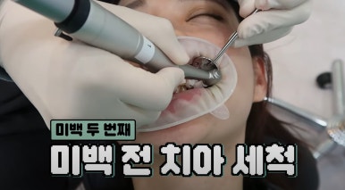 치아미백 시술,  시간과 가격 한계점까지 알려드립니다. 관련 이미지 5