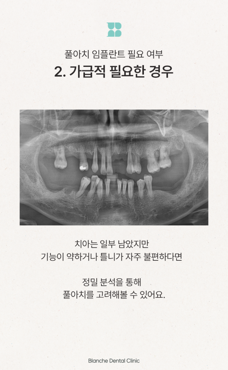 풀아치 임플란트 대상, 치료 시기와 기준을 알려드립니다 관련 이미지 6