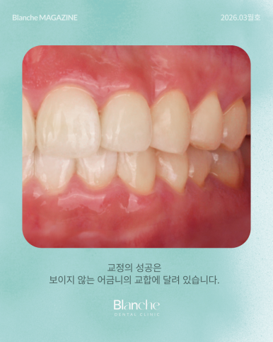 치아 교정 전 관련 이미지 6