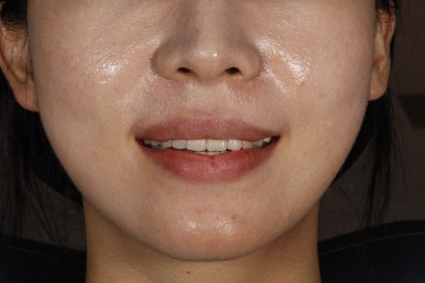 치아미백 라미네이트, 그리고 무삭제 라미네이트의 차이는? 관련 이미지 15