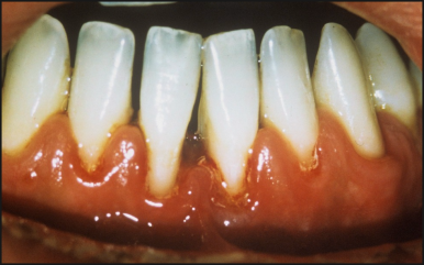 압구정 치과 50대 이후 치아 관리 이것만은 꼭 관련 이미지 2