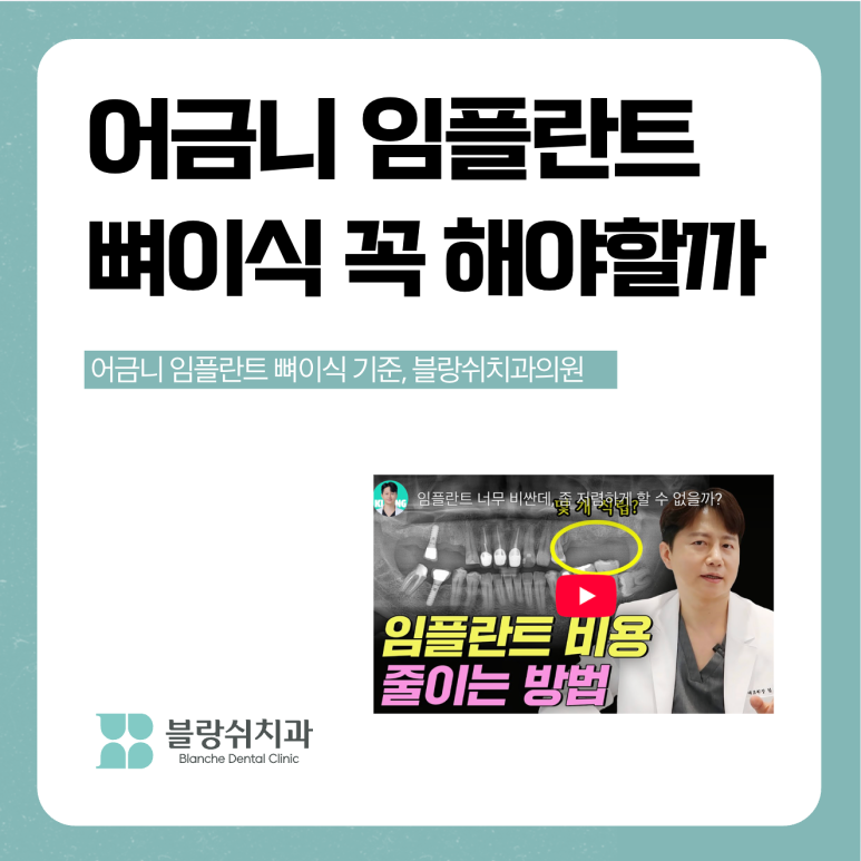 어금니 임플란트 뼈이식 통증 비용 총정리 관련 이미지 2