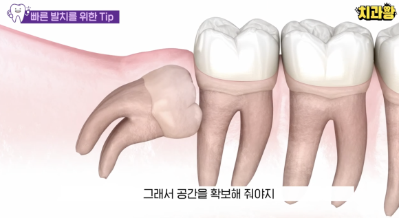 사랑니 발치 통증 붓기 언제까지?블랑쉬에서 알려드림 관련 이미지 5