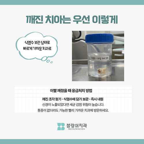 이빨 깨짐 방치하면 발치까지? 크랙치아 치료법과 응급처치 관련 이미지 3