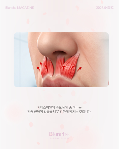 Worried About Gums Showing When You Smile? image 8